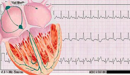 Sinus tachycardia of the heart