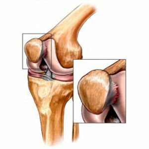 chondromolasi lutut