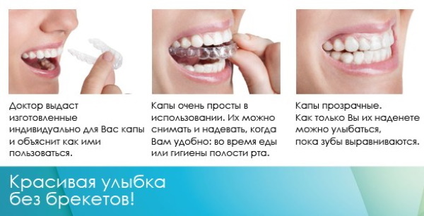 Chrániče zubů pro rovnání zubů pro děti, dospělé. Cena, pro a proti