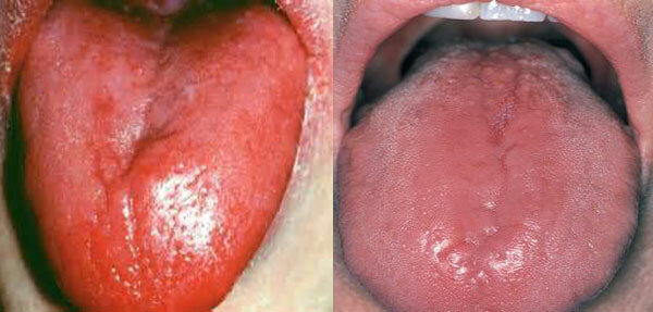 Glossitis - סימפטומים וטיפול, תמונה של הלשון