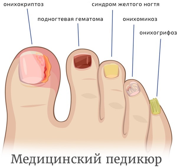 Medical pedicure. What is included in the procedure