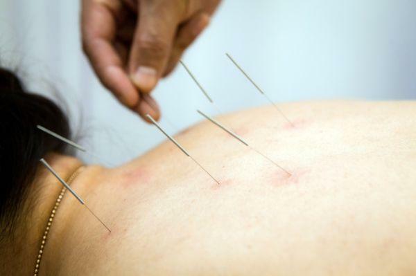 Netradiční metody léčby - akupunktura pro osteochondrózu