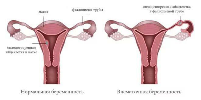 Nepotinio nėštumo schema