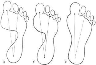 Avaliação do planograma: a - paragem normal;b - pé achatado;c - pés planos
