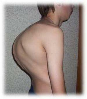 Tuberkulose av beinene i ryggraden
