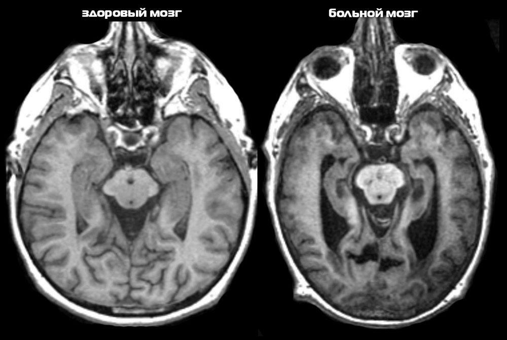 Tekenen van Alzheimer op een tomografie
