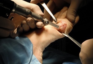 Exostosavlägsnande kirurgi
