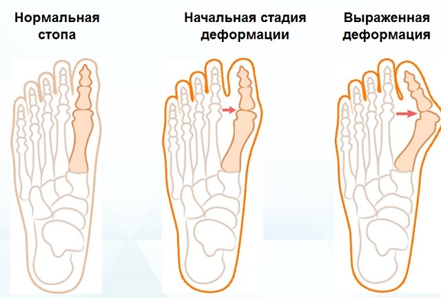Deformità valgo delle dita dei piedi
