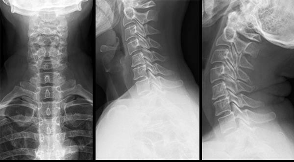 Radiografía del cuello con pruebas funcionales