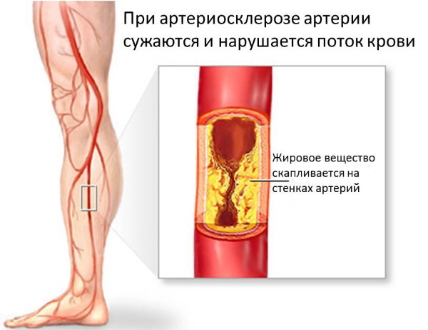 Ból mięśni nóg i ramion. Przyczyny i leczenie, leki