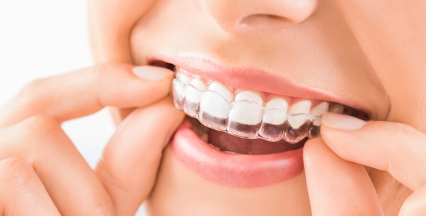 Protège-dents pour redresser les dents pour enfants, adultes. Prix, avantages et inconvénients