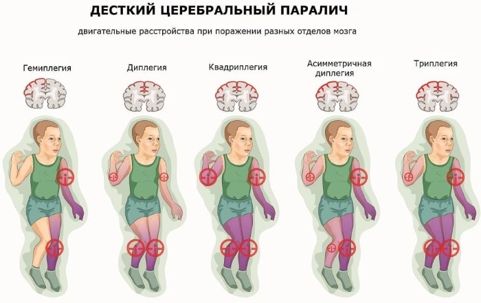 Cerebrinis paralyžius (kūdikių cerebrinis paralyžius). Priežastys vaikams, kas tai yra, gydoma ar ne