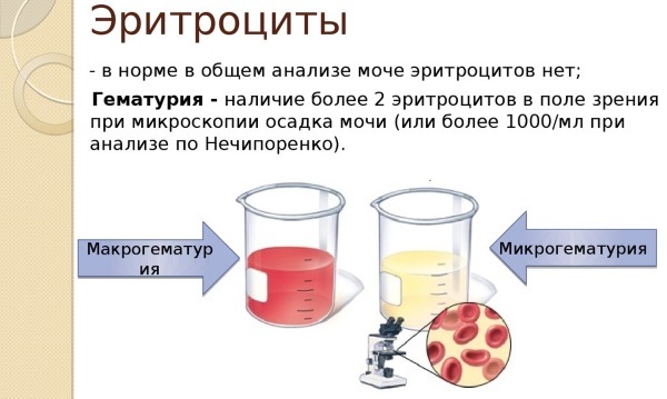 Red blood cells in urine - what it means, the rate of adult, child. Table. The causes of hematuria (high performance) in men, women, pregnancy