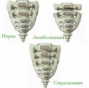 Lumbarização s1 - anomalia do desenvolvimento da coluna vertebral