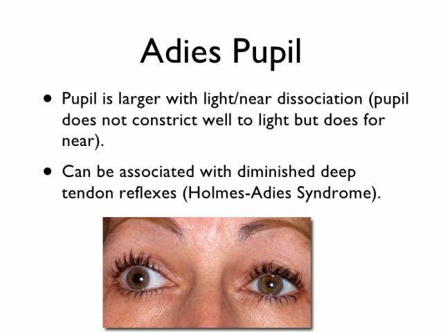 Causes, symptoms, diagnosis and evaluation of the syndrome of Adi in neurology