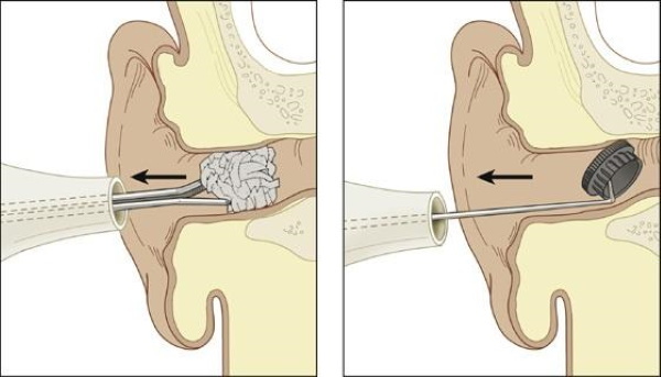 Auricle. Anatomi, struktur i midten, ydre, indre øre, funktioner