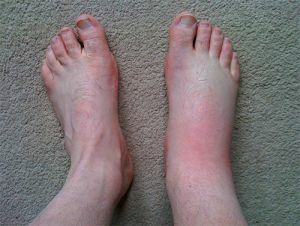 a wasp sting in a foot