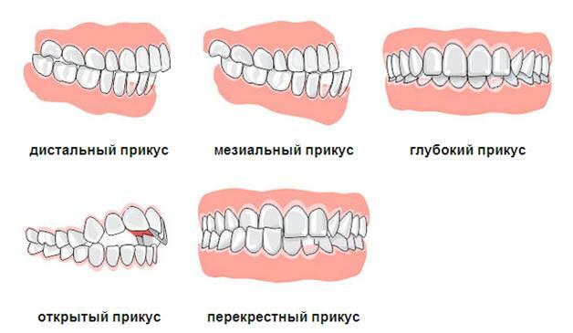5 types of malocclusion