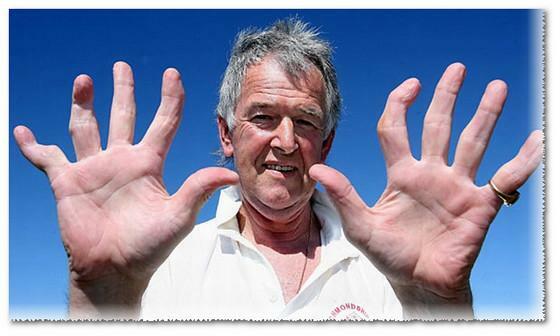 Arthritis of the fingers - photo