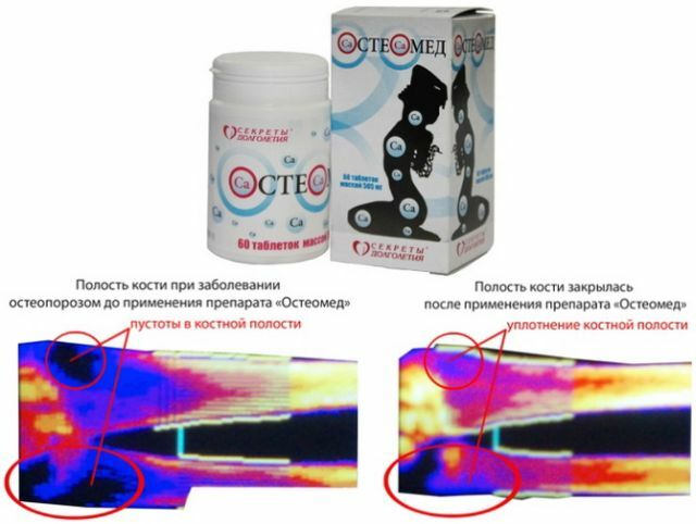 Botten voor en na het nemen van osteomedes