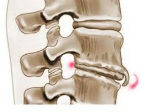 osteofyty chrbtice