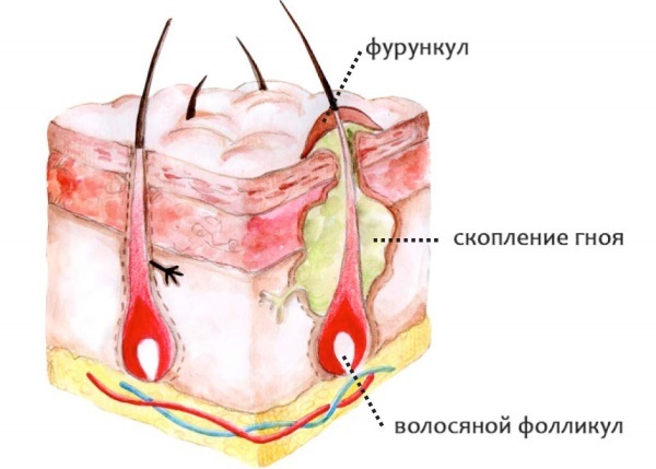 Ointment from boils pulling pus, with an antibiotic for the treatment of acne, boil on the face: Ichthyol, Vishnevsky, Triderm, Levomekol