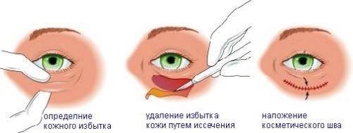 Painting bags under the eyes. Photos, causes and treatment
