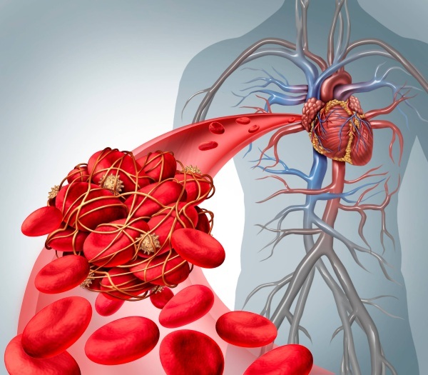 Thromboembolism. Symptoms and signs, prognosis for life, diagnosis, treatment, prevention