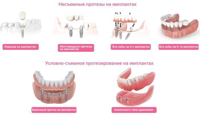 Prótese dentária condicionalmente removível em implantes para o maxilar superior e inferior. Preço
