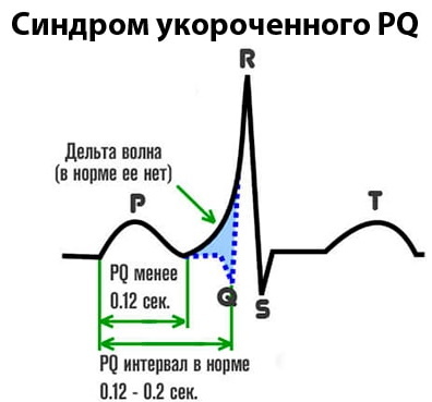 PQ shortening on ECG. What does it mean