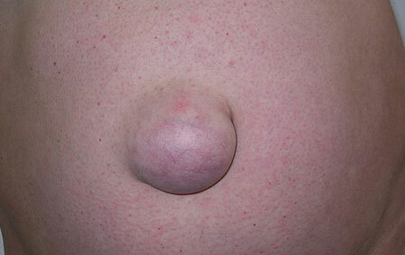 Close up de foto de hérnia umbilical