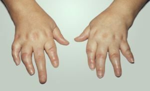 deformation of the finger