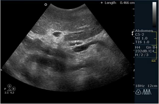 Torsie van de cyste röntgenfoto van de eierstok