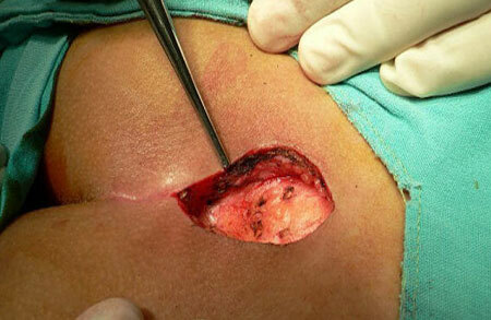 operatie om de coccyx cyste te verwijderen