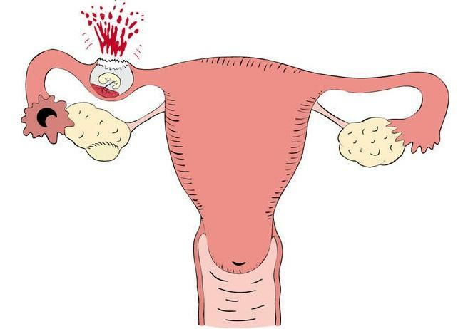Ektopična trudnoća: na koji pojam cjevčica praska