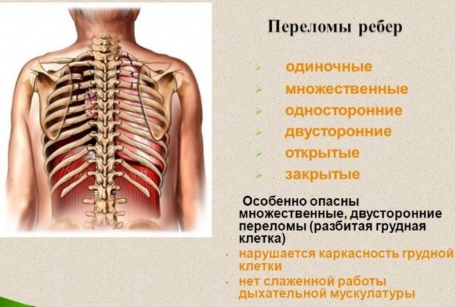 Rib fracture. Home treatment: medications, dressings, how to sleep, what to do