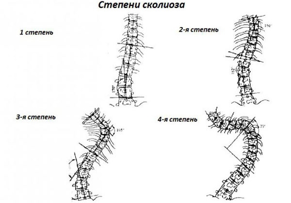 Escoliosis de 1 grado. Tratamiento, foto en forma de S, del lado derecho, del lado izquierdo en un niño, adulto, columna torácica, lumbar, ejercicios