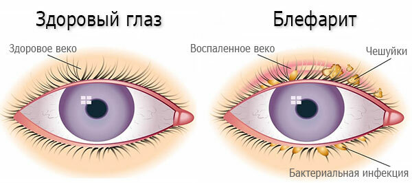 Ofloxacin-Augentropfen. Gebrauchsanweisung, Preis, Bewertungen