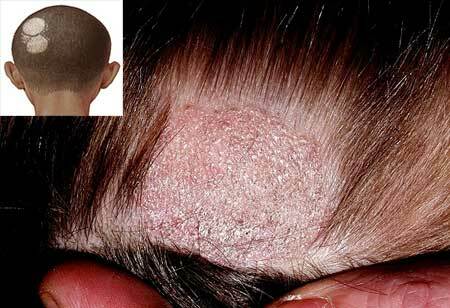 Ringworm in humans - treatment, symptoms( photo), initial stage