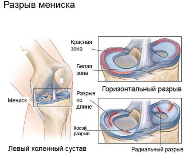 Rottura del menisco del ginocchio. Sintomi e trattamento