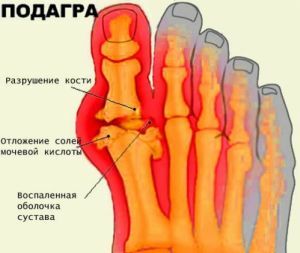 exacerbation of gout