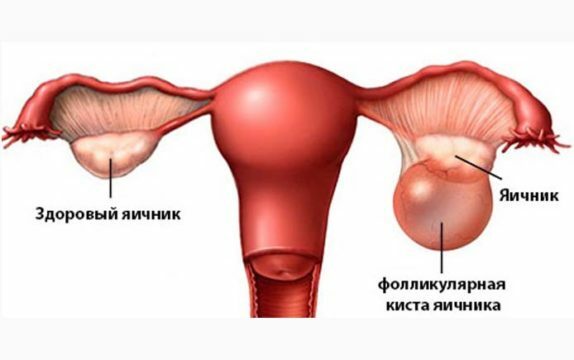 Rupture of the follicular ovarian cyst