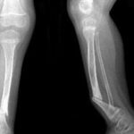 false joint after fracture