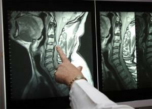 Danger of stenosis of the cervical vertebrae