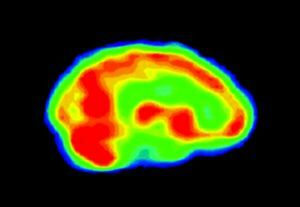 hjernens neuroaktivitet
