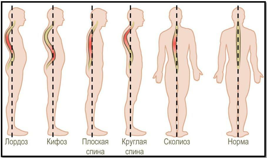 A scoliosis típusai