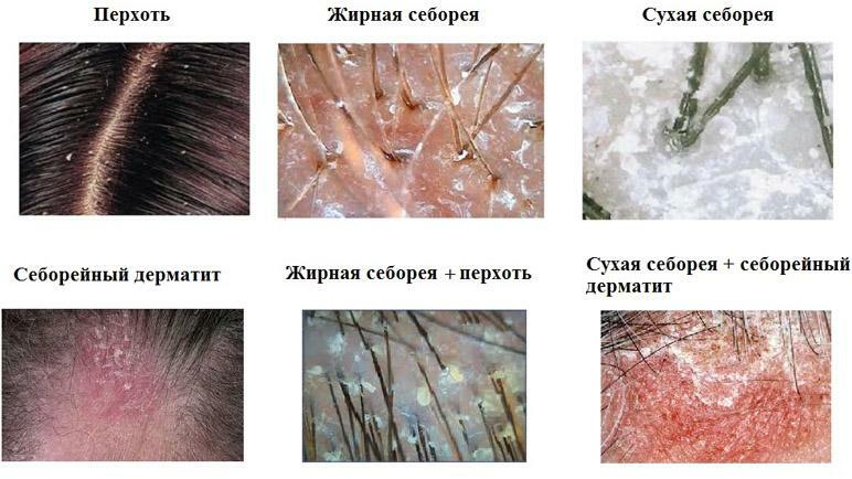 Arten von Seborrhoe der Kopfhaut