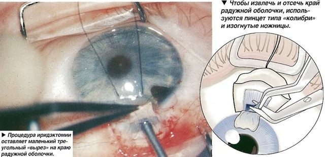 Laser iridectomy. What is it, indications, postoperative period, restrictions, price