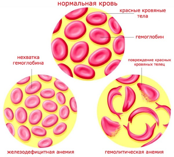 Eritroblastose fetal. Ou seja, tratamento, orientações clínicas