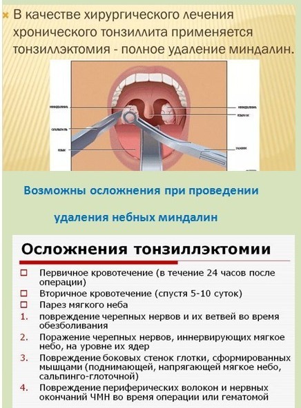 Removal of tonsils. Reviews and consequences for adults, children